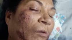Info Martí | Madre de preso político se recupera de asalto y golpiza en la vía pública