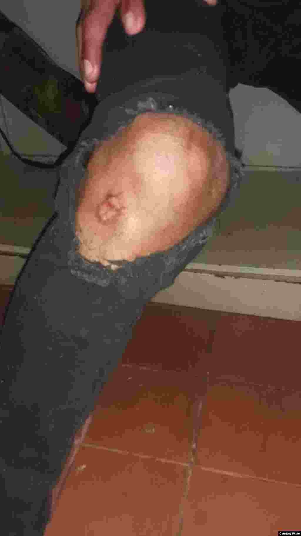 Uno de los migrantes muestra el golpe en la rodilla que recibió durante el desalojo.